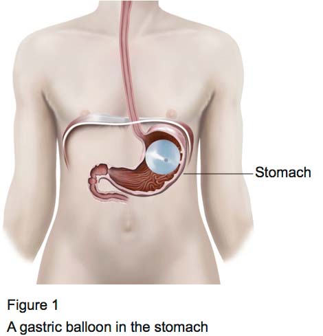 Gastric Balloon New Victoria Hospital